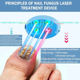 Nail Fungus Laser Treatment Device Repair Toenail Fingernail Fungus Treat Onychomycosis Laser Nails with Mushrooms Relaxation